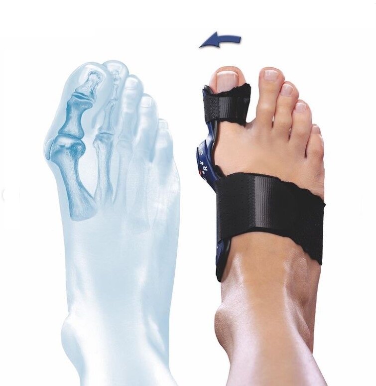 TEENCORRECTIE--Hallux-Valgus